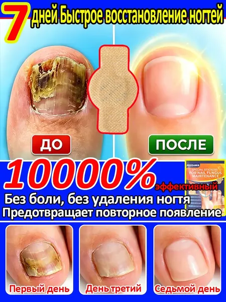 Антигрибковые наклейки для лечения ногтевого грибка,избавление от онихомикоза и воспаления паронихита,быстрое восстановление ногтевой пластины,снятие дискомфорта,удобное использование,1упаковка/21шт