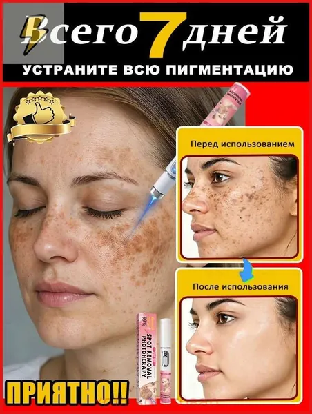 Лазерное лечение веснушек и пигментных пятен: улучшает состояние кожи лица, выравнивает тон кожи, удаляет пигментные пятна, веснушки, пятна от солнечных ожогов, мелазму, угревую сыпь и морщины.