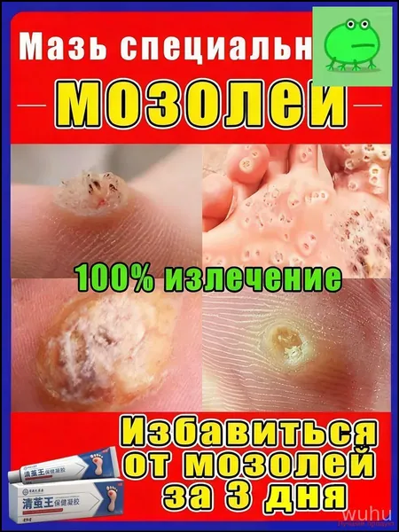 Эффективный крем для быстрого избавления бородавок, мозольный удаления мозолей, натоптышей,средство от шипиц на ногах,китайская чудо мазь 20 г от мазолей и надоптвшей,колломак от бородавок