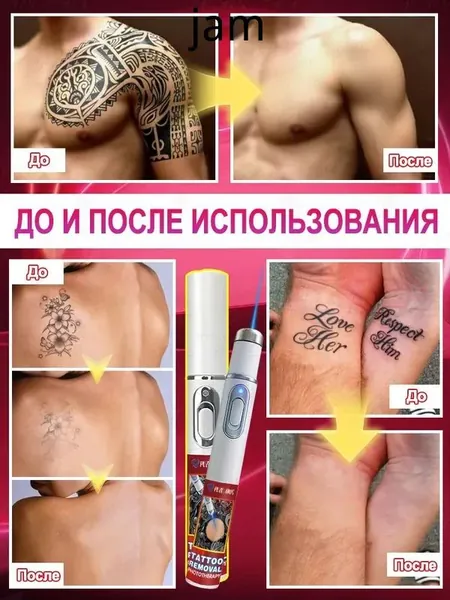Удаление татуировок