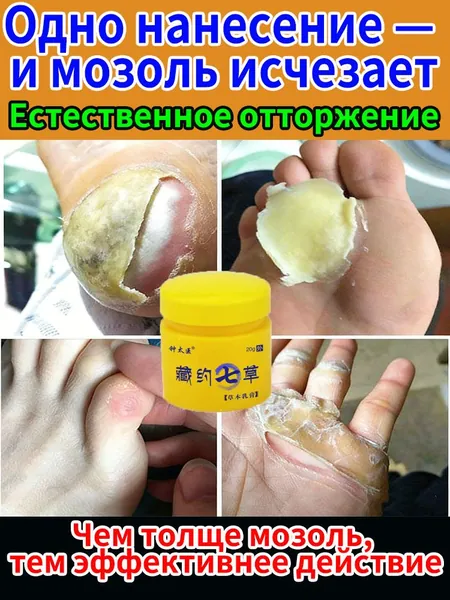 Эффективный крем для быстрого избавления бородавок, мозольный удаления мозолей, натоптышей,средство от шипиц на ногах,китайская чудо мазь 20 г от мазолей и надоптвшей,колломак от бородавок